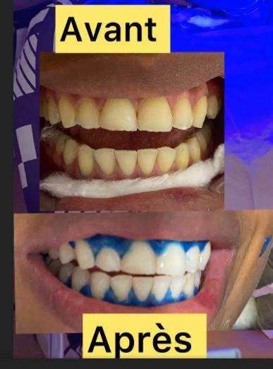 Dents avant et après une séance de blanchiment au fauteuil dans un cabinet partenaire de Dentist237 à Yaoundé